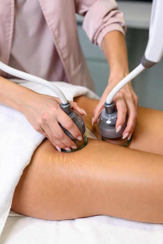 tratamento estrias tratamento estrias